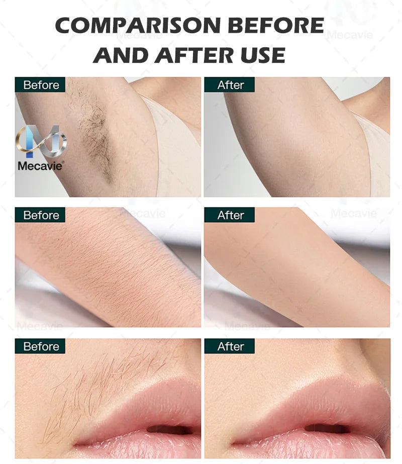 Professional 4-Wave 808nm Diode Laser Hair Removal | 4000W Soprano Titanium | Face & Body