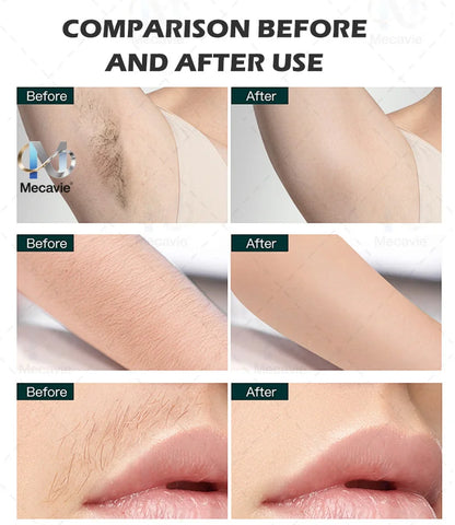 Professional 4-Wave 808nm Diode Laser Hair Removal | 4000W Soprano Titanium | Face & Body