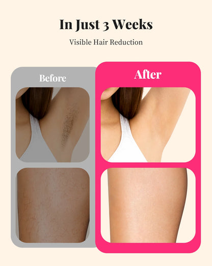 IPL Laser Hair Removal Device – 990,000 Flashes, Painless Permanent Hair Removal for Women & Men