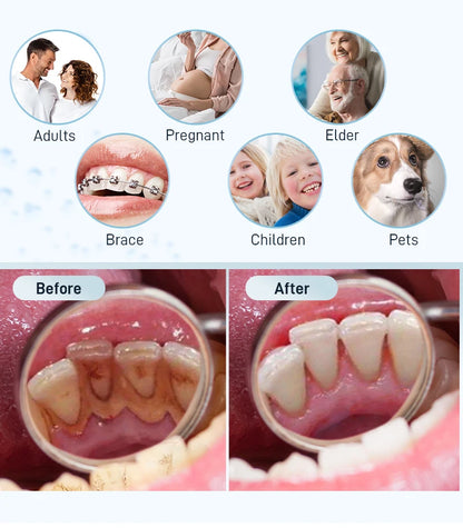 Schoben Ultrasonic Dental Scaler | Tartar & Plaque Remover | Electric Tooth Stone Cleaner