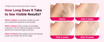 IPL Hair Removal Device – 990,000 Flashes, Permanent Painless Hair Remover for Men & Women, Body & Face